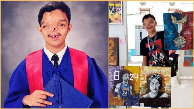 Senior High Student With Facial Cleft Graduated With Flying Colors, Inspired Many.